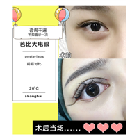 上海做眼综合价格@上海做芭比眼综合多少钱
