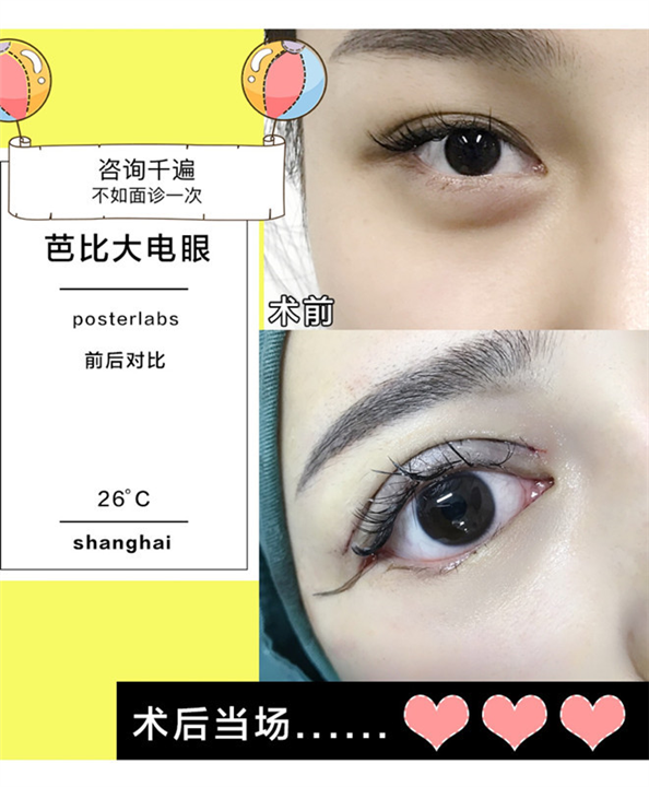 上海做眼综合价格@上海做芭比眼综合多少钱