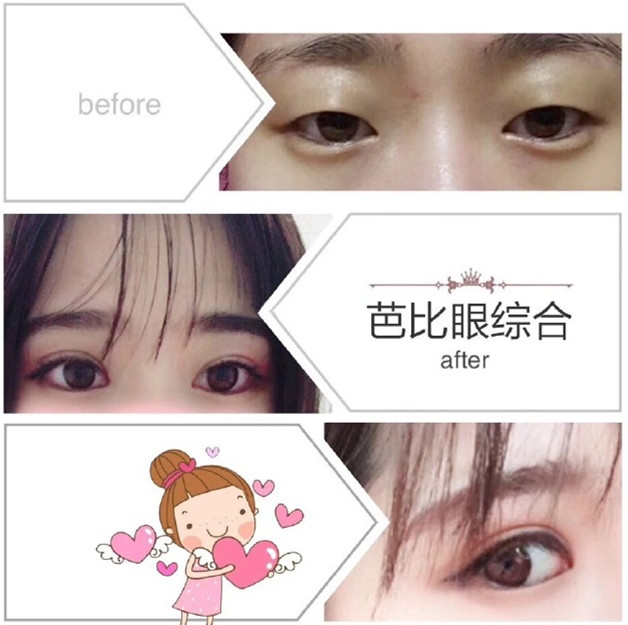 上海星璨人气网红整形医院 芭比眼打造 
