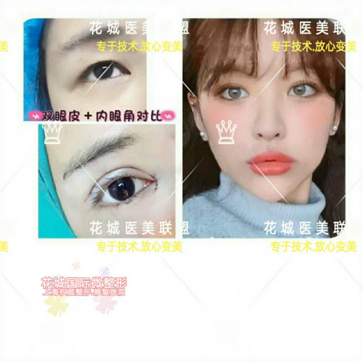 上海芭比眼整形、上海做眼综合多少钱