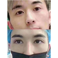 星璨整形修复医院 男士双眼皮术后即刻 