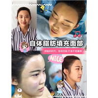 上海星璨整形自体脂肪填充脸部 