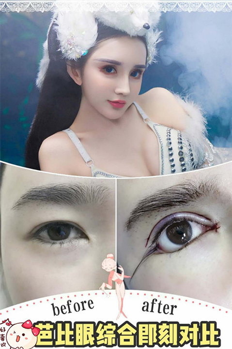上海芭比混血眼综合整形 术后即刻