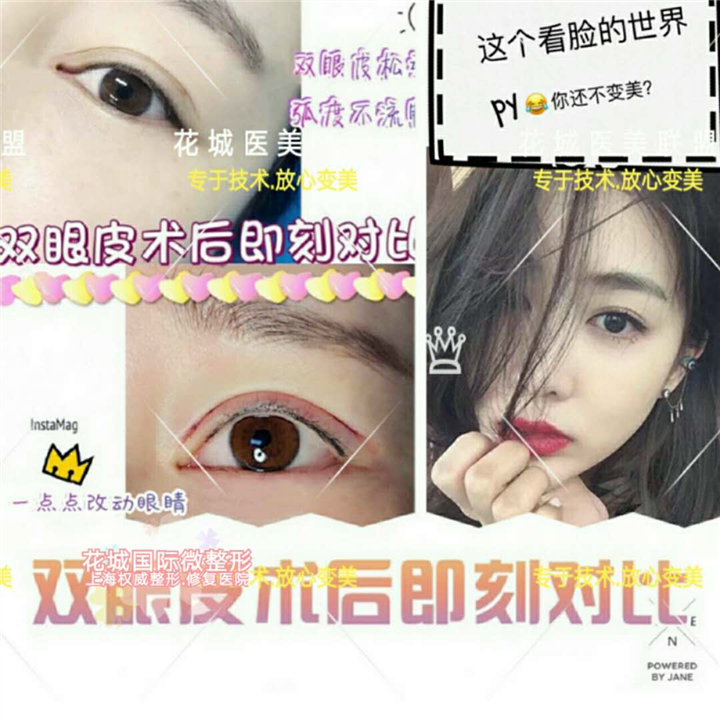 上海双眼皮整形 上海双眼皮整形哪家好