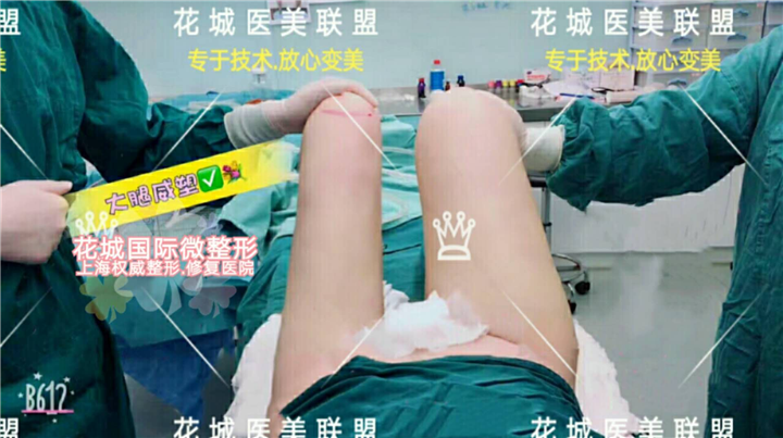 上海星璨国际整形医院 大腿环吸术 