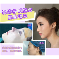 上海星璨国际鼻综合 眼综合 脂肪填充 