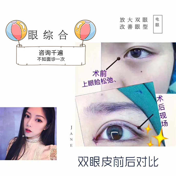 上海星璨整形双眼皮案例 术后对比 