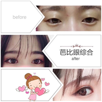 上海星璨人气网红整形医院 芭比眼打造 