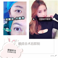 上海双眼皮整形修复医院哪家好？