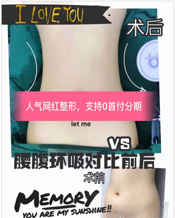 上海星璨整形@上海做大腿抽脂整形多少钱 