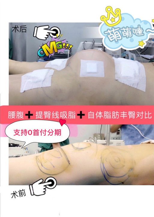 腰腹+提臀线吸脂+自体脂肪丰臀对比