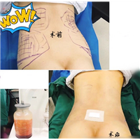 上海星璨国际整形 腰腹环吸术后即刻 