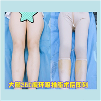 上海人气网红整形医院 大腿抽脂案例