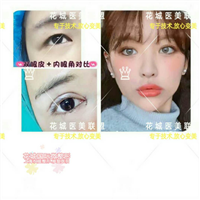 上海芭比眼整形、上海做眼综合多少钱