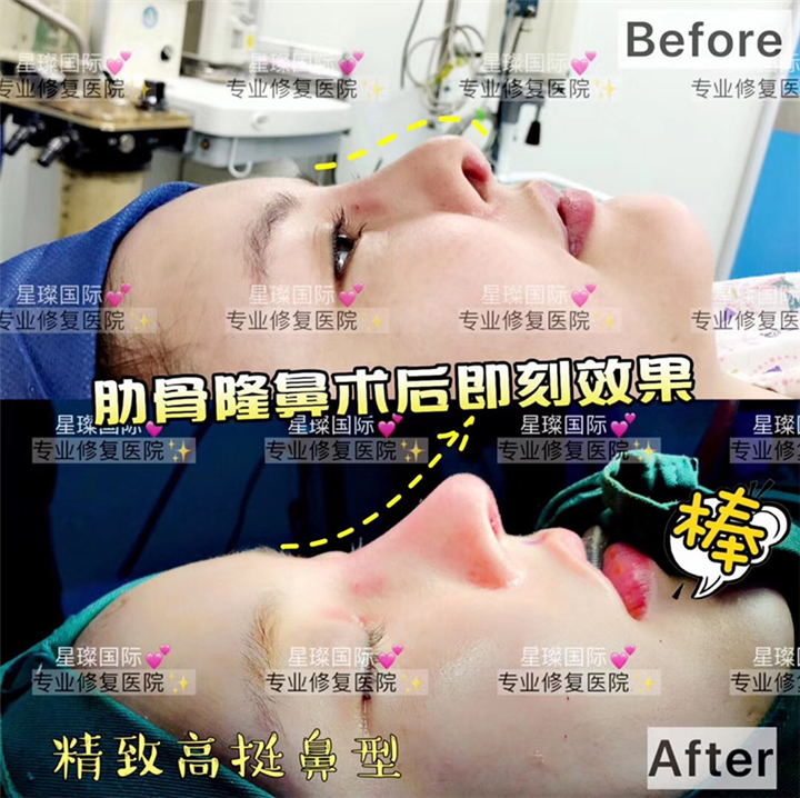 上海鼻部整形失败修复医院哪家好？ 