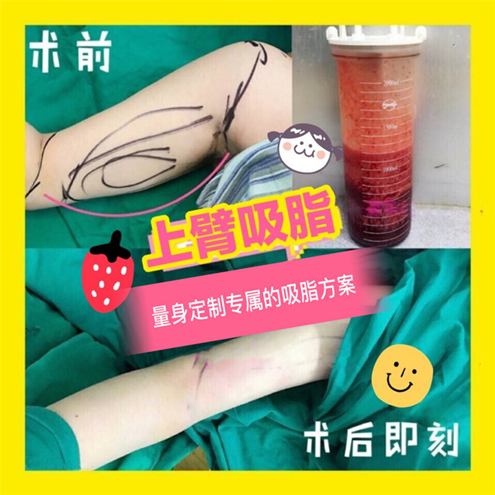 手臂吸脂案例@上海手臂吸脂价格