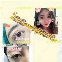 眼综合整形术后一个月反馈