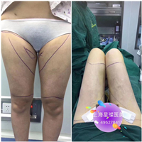抽脂多少钱