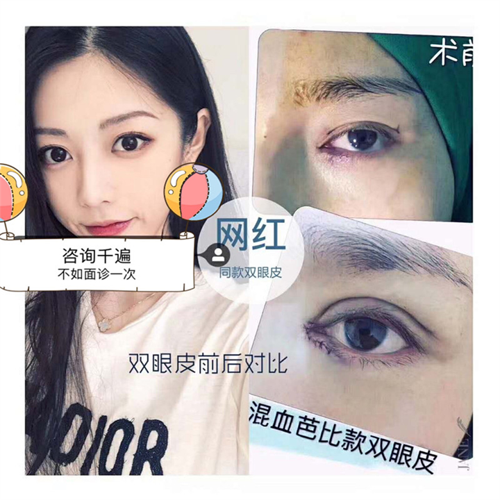 上海网红打造 混血芭比款双眼皮