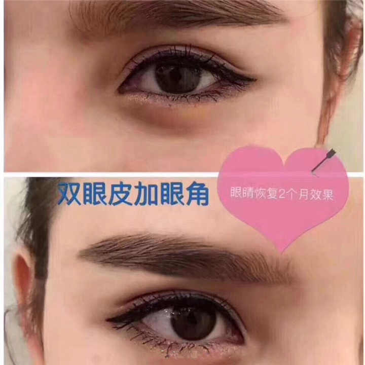 眼睛恢复2个月效果