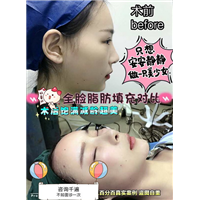 上海星璨国际整形 自体脂肪填充对比 