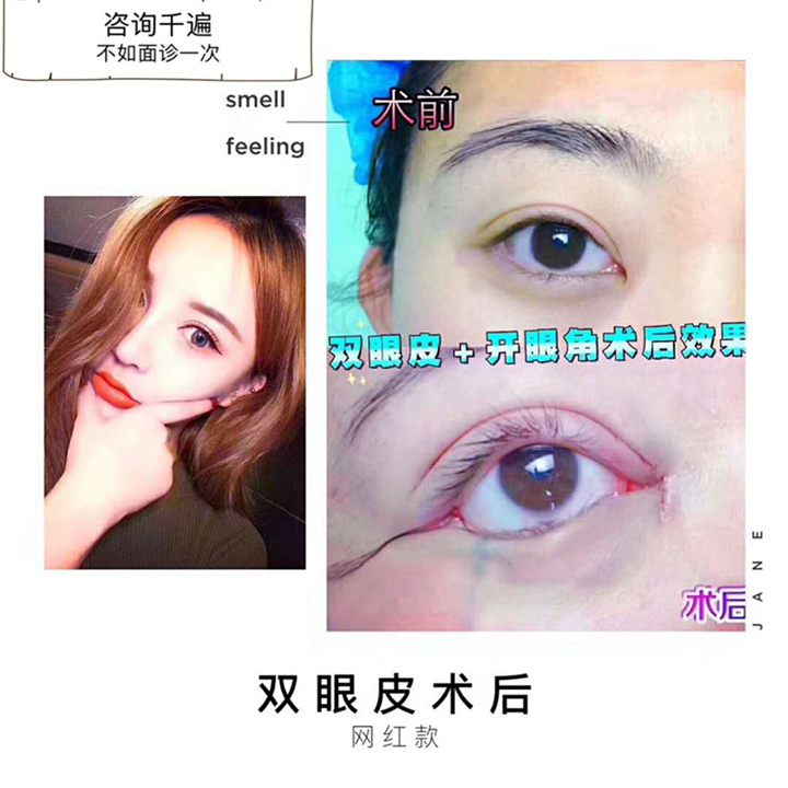 上海星璨整形 双眼皮+开眼角术后即刻效果 