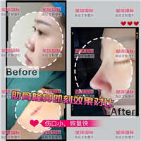 上海星璨整形 肋软骨鼻综合整形术后 