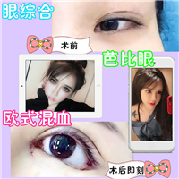 上海欧式混血芭比眼整形术后即刻