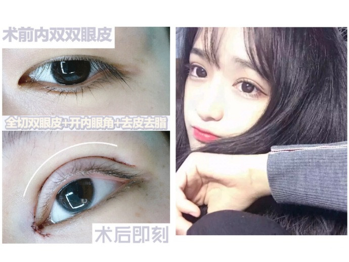 上海眼综合整形 术后即刻效果