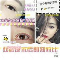 上海双眼皮整形 上海双眼皮整形哪家好