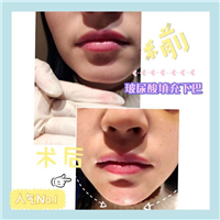 上海芭比眼整形|上海做眼综合多少钱 