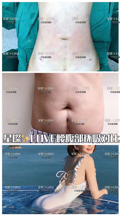 上海抽脂