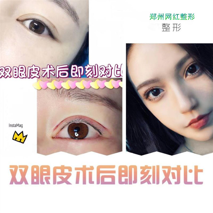 双眼皮术后即刻对比