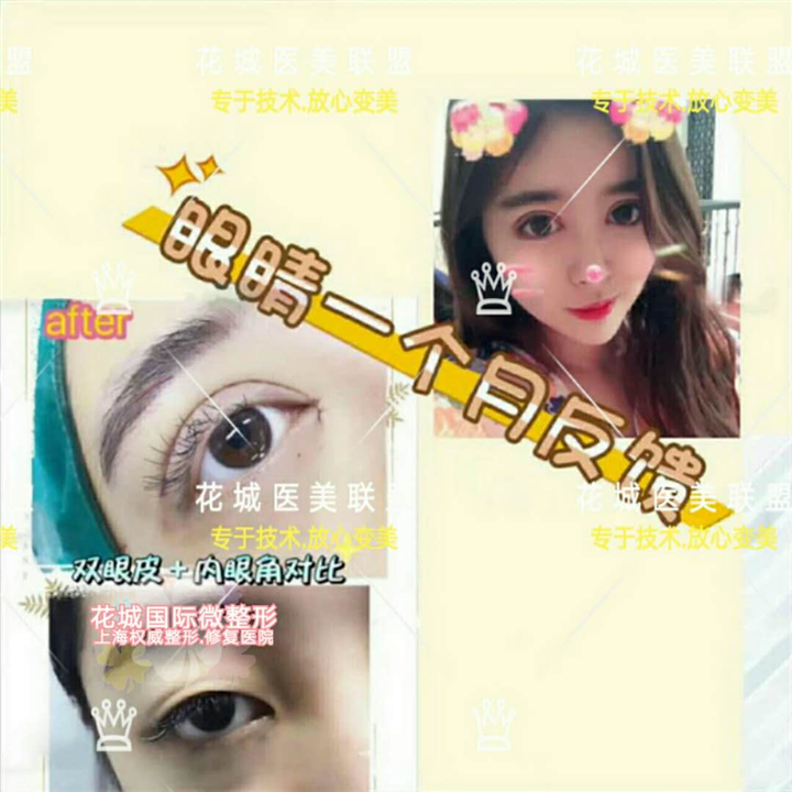 眼综合整形术后一个月反馈