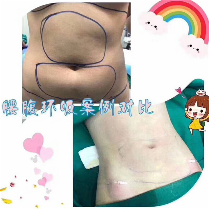 腰腹环吸案例对比