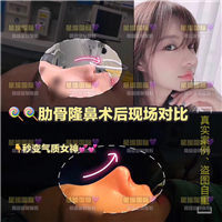 上海星璨肋骨隆鼻术后现场对比 