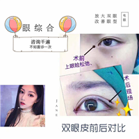 上海星璨整形双眼皮案例 术后对比 