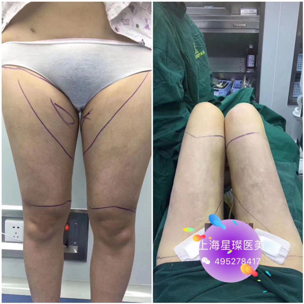大腿360度环吸术后反馈 
