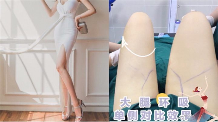大腿环吸单侧效果对比