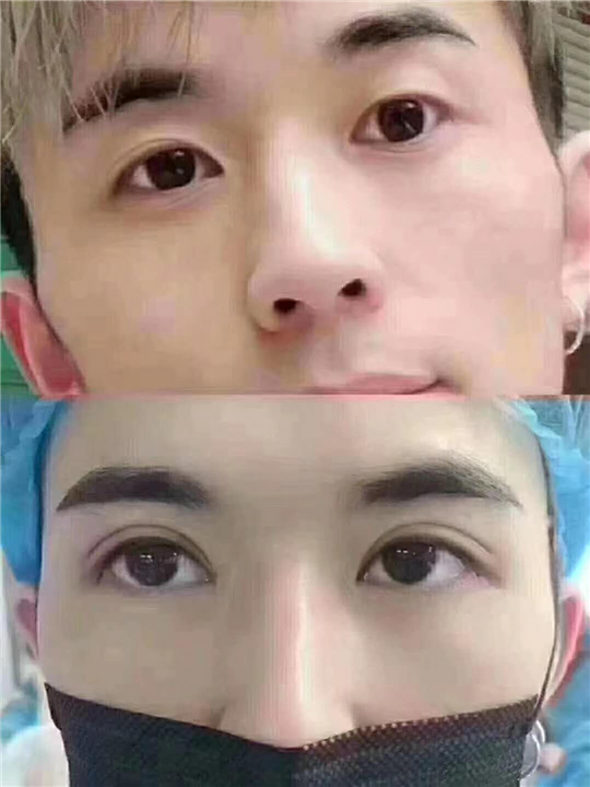 星璨整形修复医院 男士双眼皮术后即刻 