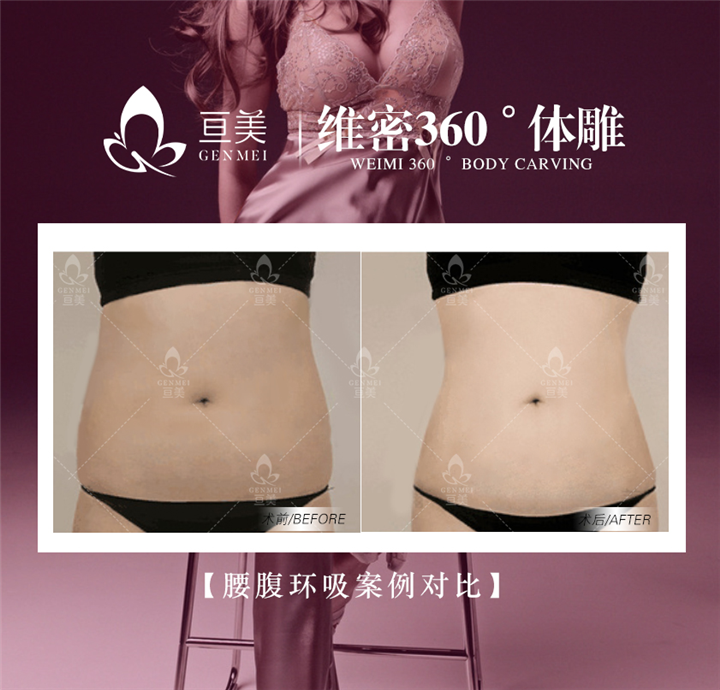 南昌吸脂整形多少钱