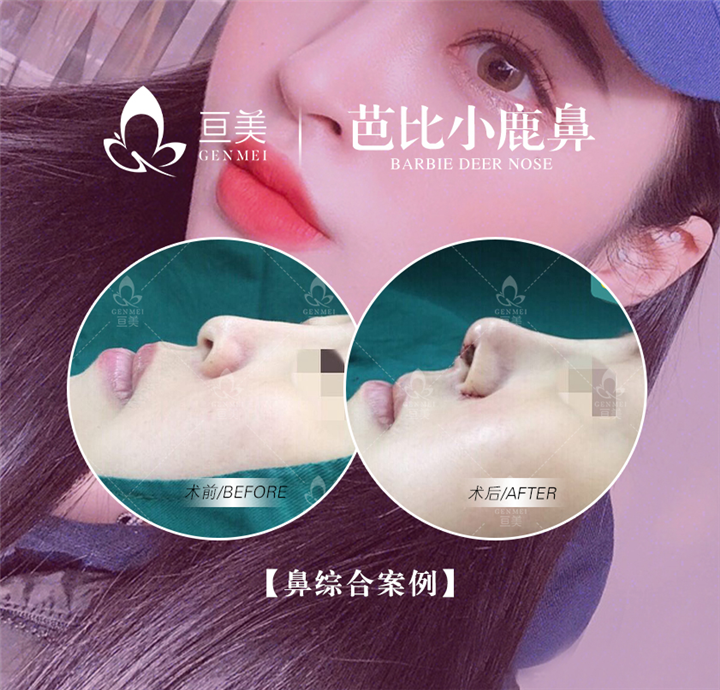 南昌亘美小翘鼻