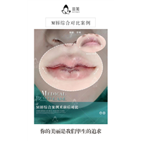 南昌M唇综合案例