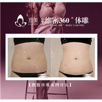 南昌吸脂整形多少钱