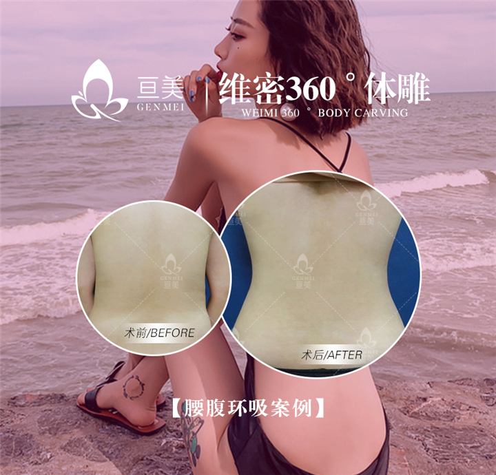 南昌吸脂整形哪家好