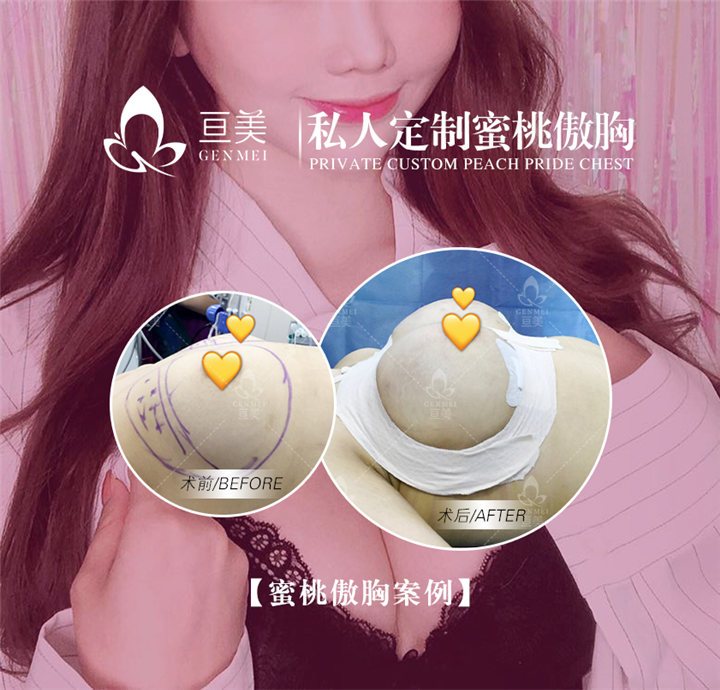 南昌隆胸整形哪家好