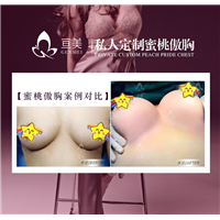 南昌隆胸整形