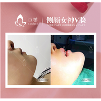 南昌下巴整形