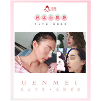 南昌鼻修复