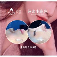 亘美医疗鼻整形怎么样